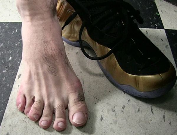 Petinju Belum Terkalahkan ini Punya Enam Jari Kaki