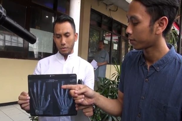 Sadis, 3 Jari Karyawan Kafe di Malang Remuk Dipalu Bos