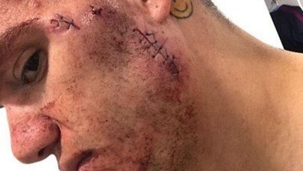 Penampakan Ederson Setelah Dapat Delapan Jahitan di Wajah