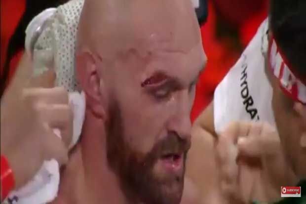 Luka Mata Kanan Tyson Fury Murni Pukulan Tangan Kiri Otto Wallin