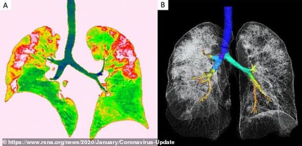 Bikin Bulu Kuduk Merinding, Ini Foto X-ray Paru-Paru Pasien Corona