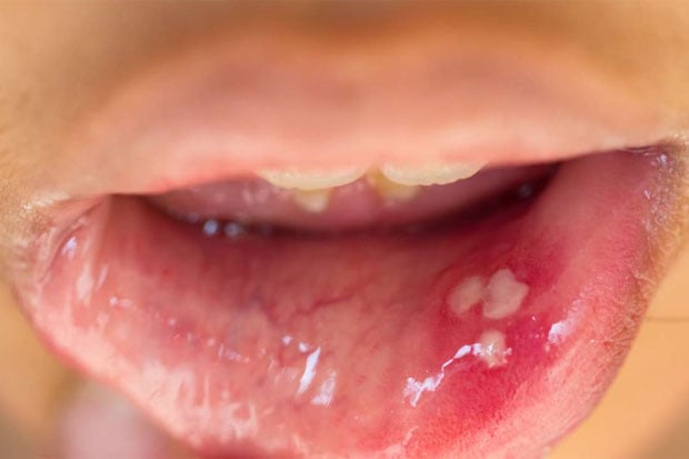 Jangan Lakukan Pada Istrimu, Bahaya Seks Oral yang Bikin Menyesal